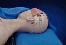 Прорив у контролі розуму: паралізована людина керує пристроями через кілька днів після імплантації