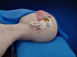 Прорив у контролі розуму: паралізована людина керує пристроями через кілька днів після імплантації