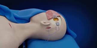 Mind Control Breakthrough: Paralyzed Man Operates Devices Days After Brain Implant